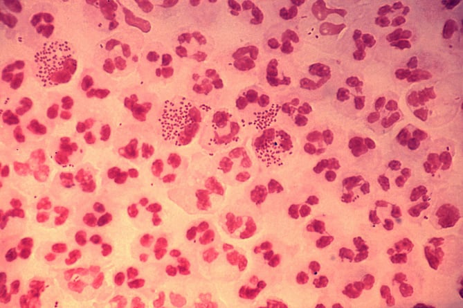 Gram stain of the bacteria causing  gonorrhea