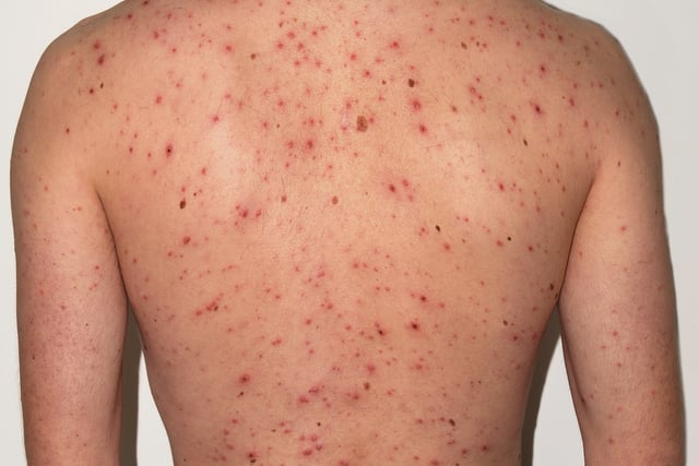 New NHS jab aims to cut chickenpox cases across Cornwall