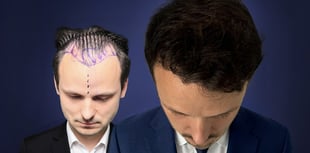 What everyone  should know before booking a hair transplant in Turkey