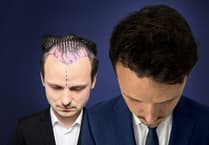 What everyone should know before booking a hair transplant in Turkey
