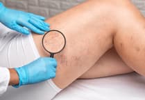 Why do veins suddenly become visible on the legs?